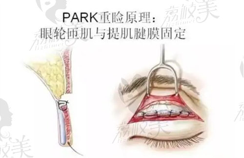 PARK眼示意圖