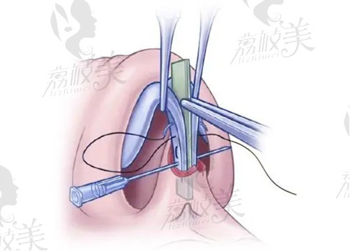 鼻部整形示意圖