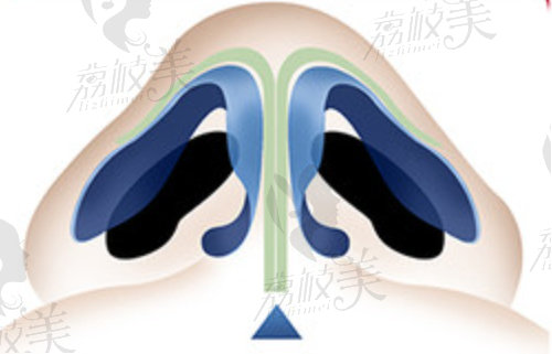 温州艺星谭立文医生隆鼻技术好