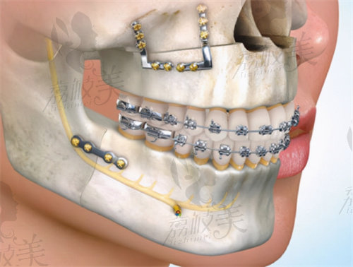 正颌手术动画示意图