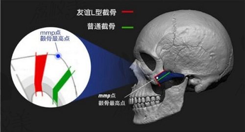 张立天L型截骨.jpg