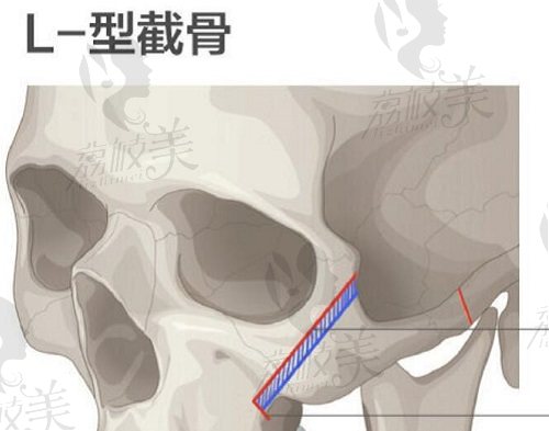 张立天颧骨内推L型截骨术式