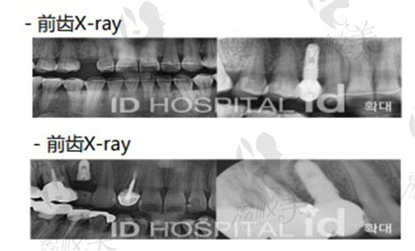 韩国ID牙科医院种植牙病例