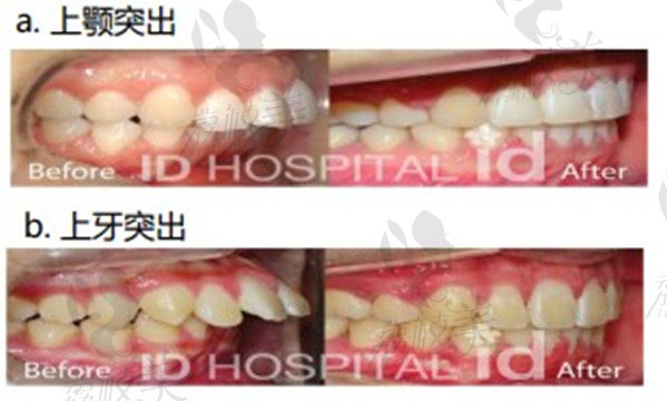 韩国ID牙科医院突嘴矫正病例