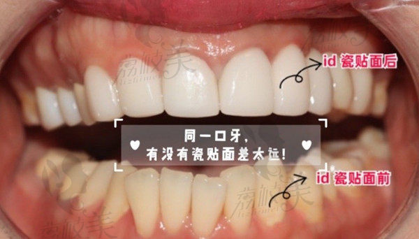 韩国ID牙科医院瓷贴面病例