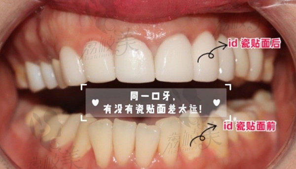 韩国ID牙科医院瓷贴面病例 韩国ID牙科医院瓷贴面病例