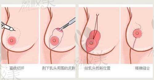 悬吊法乳房下垂矫正手术