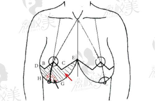 乳房下垂矫正术