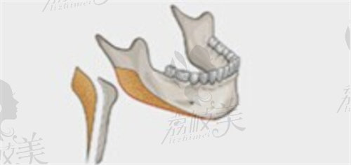 下颌角截骨示意图