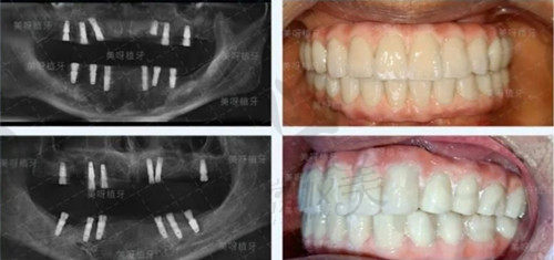 成都美呀植聯(lián)口腔種牙靠譜嗎