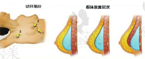 隆胸切口及假体放置示意图