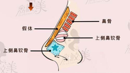 王英勇的半肋鼻综合