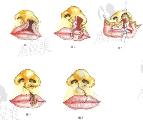 唇裂修复示意图