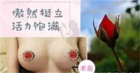 深圳南雅医疗美容胸部整形实例