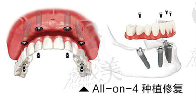 陈刚医生在all-on-4种植手术方面的技术优势4