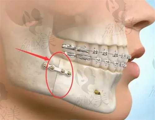 正颌手术示意图