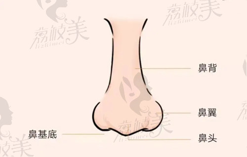 王志医生做肋软骨鼻综合有效改善鼻头