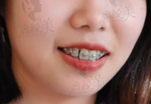 杭州齐尔口腔正畸如何