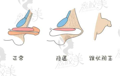 陰莖短小癥狀