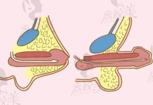 北京达美如艺医疗阴茎短小手术原理