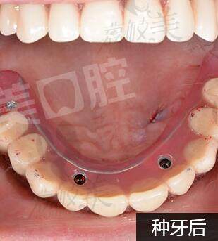 北京冠美平乐口腔门诊部种植牙术后反馈