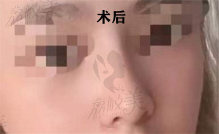 廣西南寧愛(ài)思特整形王楷醫(yī)生隆鼻實(shí)例