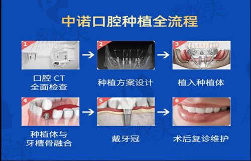  北京中诺第二口腔医院种植全过程