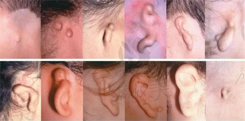 耳朵畸形图片