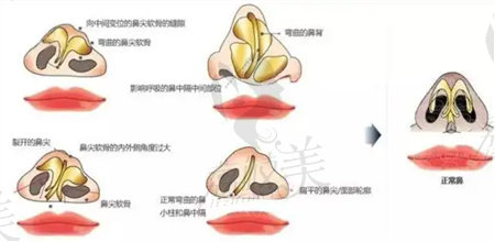 需要做鼻修復(fù)的類型