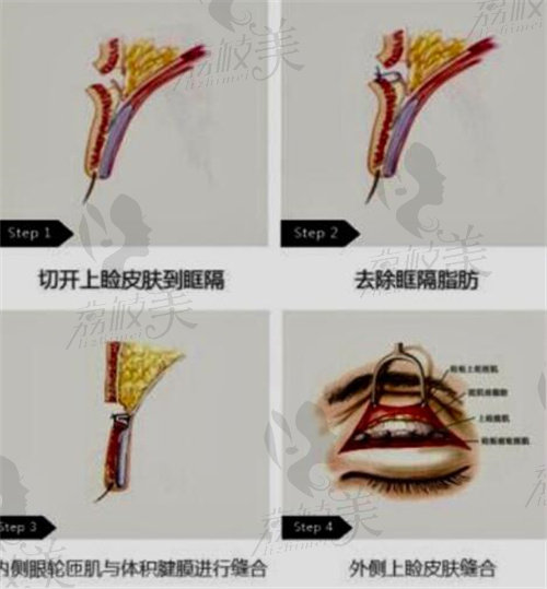 杨亚益park修复技术