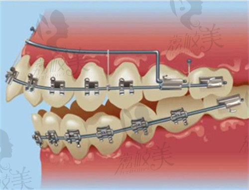 2022杭州余杭口腔医院牙齿矫正价格表