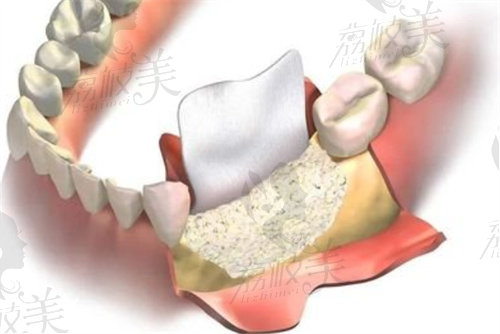 种植牙添加骨粉示意图