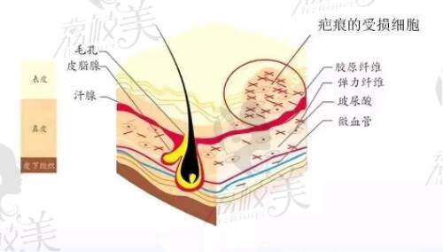 北京国丹医院凹陷型疤痕治疗方式