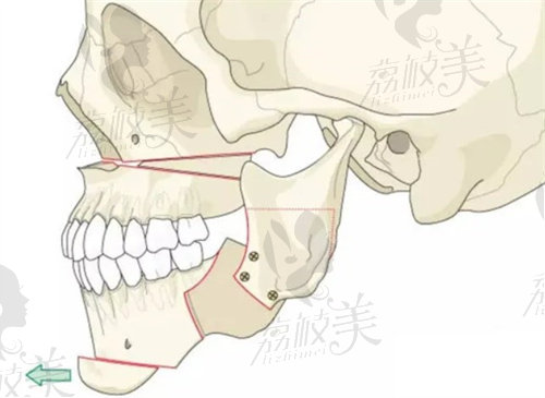 正颌手术示意图