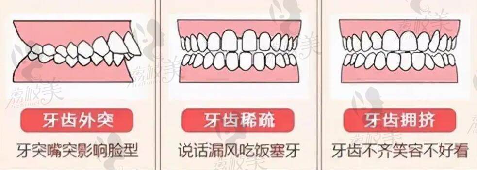 牙齒不齊造成的問(wèn)題