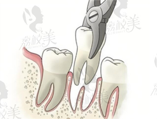 干槽症一般是拔牙3-4天发生