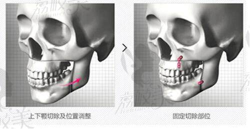 韩国WJ原辰整形外科双鄂手术