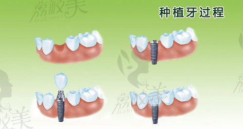 种植牙过程