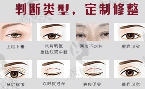 北京高难度双眼皮修复医生哪个厉害?这几位眼修复厉害价格能接受