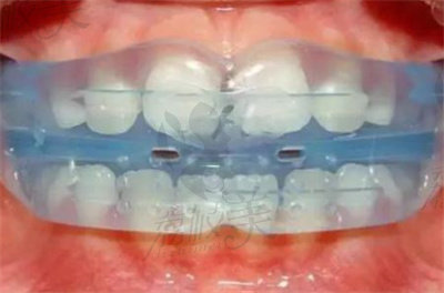 肖林喜医生在牙齿矫正方面的技术优势1