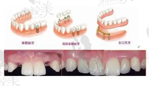 杭州美萊口腔種植牙針對(duì)人群