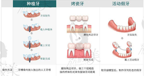 镶牙活动优缺点