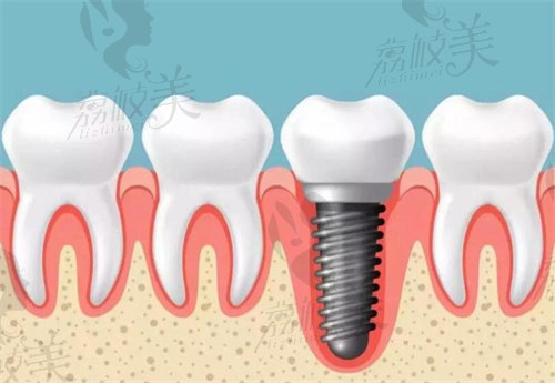 牙龈萎缩可选择种植牙