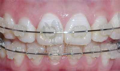 赖跃辉医生在牙齿矫正方面的技术优势3