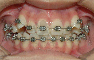 赖跃辉医生在牙齿矫正方面的技术优势2