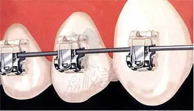 赖跃辉医生在牙齿矫正方面的技术优势1