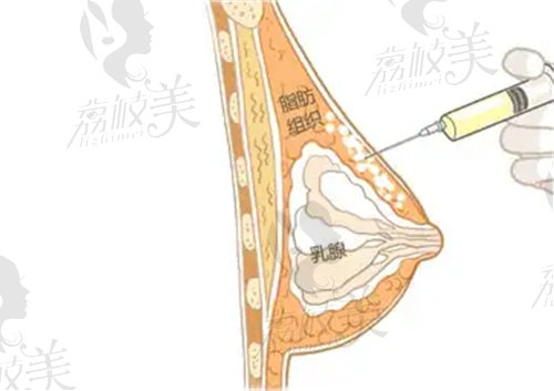 杭州连天美做自体脂肪隆胸技术不错