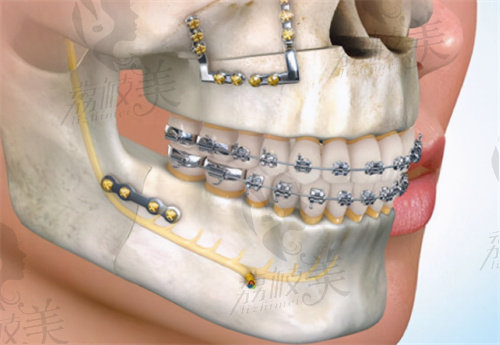 正颌手术示意图