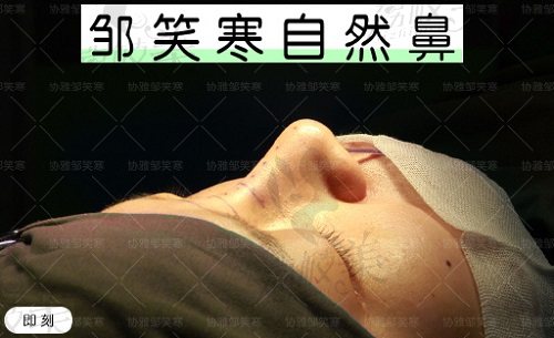 长沙协雅邹笑寒医生隆鼻范例