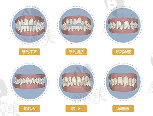 牙齿矫正适应症